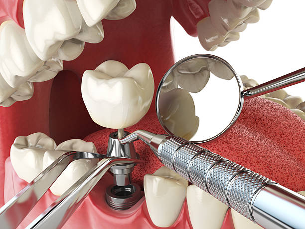 Best Emergency Tooth Extraction in Thompsonville, CT